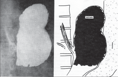 Obr. 4b – Kontrastní vyšetření žaludku prokazuje normální uložení kardie a dislokaci žaludku kraniálně do hrudníku. Laterálně a dorzálně od něj je patrný nehomogenní nativní obsah tlustého střeva