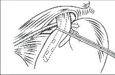 Obr. 27 - Otevření viscerálního peritonea nad terminálním jícnem a tupá preparace jícnu pomocí tamponku