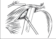 Obr. 28 – Zavěšení jícnu na hadičku a zavedení rotikulátoru za jícen k uchopení fundu žaludku