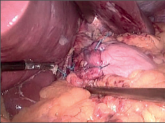   Obr. 32  - Laparoskopický pohled: c – sutura obou částí manžety před jícnem