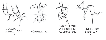 Obr. 14 – Zmenšení dilatovaného jícnu: a) segmentální resekce hrudního ezofagu (Pribram 1912) a současná myotomie. Výkony vyřazující žaludek: b) jejunální by-pass, anterotorakální transpozice žaludku a krční gastrostomie, c) využití Rouxovy kličky, které Allison doplnil anastomózou jejuna se zadní stěnou žaludku, d) resekce GES a end-to-end anastomózaObr. 14 – Zmenšení dilatovaného jícnu: a) segmentální resekce hrudního ezofagu (Pribram 1912) a současná myotomie. Výkony vyřazující žaludek: b) jejunální by-pass, anterotorakální transpozice žaludku a krční gastrostomie, c) využití Rouxovy kličky, které Allison doplnil anastomózou jejuna se zadní stěnou žaludku, d) resekce GES a end-to-end anastomóza