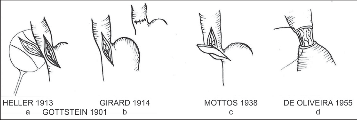 Obr. 17 – Ezofagokardiální myotomie: a) původní Hellerův postup se dvěmi incizemi na přední a zadní stěně jícnu, b) myotomie (kardioplastika) s příčným sešitím svaloviny bez porušení sliznice, c) excize svalového pruhu v rozsahu myotomie, d) ezofagokardiální myotomie se zanořením slizničního válce do jícnu, nebo je výkon možno doplnit fundoplikací