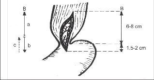 Obr. 18 – Schéma ezofagokardiální myotomie: a – délka myotomie, B – směr prováděné myotomie, a – první, b – druhá fáze postupu obvyklá z torakotomie, c – možný směr postupu druhé fáze z laparotomie