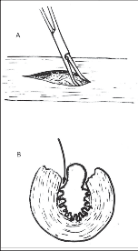 Obr. 19 – Preparace při myotomii: A – odpreparování svaloviny od sliznice, B – částečné odsunutí svaloviny laterálně