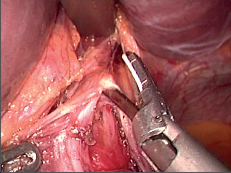 Obr. 22b – Reálný pohled na laparoskopickou myotomii pomocí harmonického skalpelu