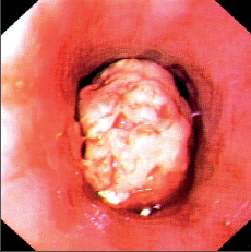 Obr. 12c – Endoskopický obraz karcinomu jícnu