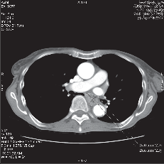 Obr. 13a – CT obraz karcinomu jícnu v axiální projekci, uvedeny rozměry nádorů v příčném řezu