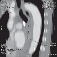 Obr. 13b – CT obraz, sagitální rekonstrukce, délka nádoru 66,9 mm