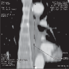 Obr. 13c – CT obraz, koronární rekonstrukce (frontální řez), délka tumoru 65,8 mm