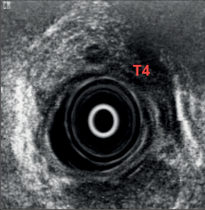 Obr. 14b – Endosonografický obraz karcinomu jícnu (T4)