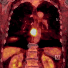 Obr. 15a – PET/CT obraz karcinomu jícnu; nádor ve střední části jícnu bez generalizace