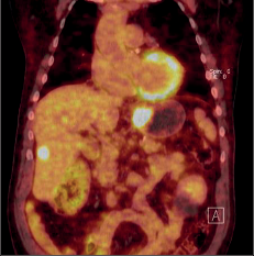 Obr. 15c – PET/CT obraz karcinomu jícnu s rozsáhlou generalizací nádoru