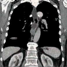 Obr. 15b – CT obraz karcinomu středního jícnu u nádoru zobrazeného na PET na obr. 15a