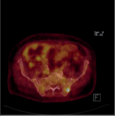 Obr. 15d – PET/CT obraz karcinomu jícnu s rozsáhlou generalizací nádoru v transverzálním řezu