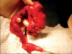 Obr. 21 – Krční fáze operace, do krční incize je vtažen žaludeční tubus a uvolněný jícen s tumorem a subkardiální částí žaludku