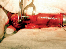 Obr. 22b – Vytváření krční anastomózy mezi jícnem a žaludečním tubusem pomocí kruhového stapleru