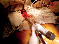 Obr. 22a – Vytváření krční anastomózy mezi jícnem a žaludečním tubusem pomocí kruhového stapleru
