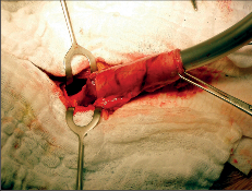 Obr. 22c – Vytváření krční anastomózy mezi jícnem a žaludečním tubusem pomocí kruhového stapleru