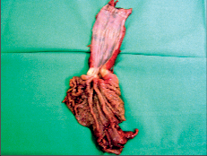 Obr. 23 – Operační preparát adenokarcinomu v abdominální části jícnu