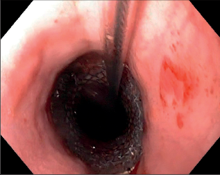Obr. 5 – Endoskopický pohled na zavedený obdukovaný stent do jícnu při dehiscenci gastroezofageální anastomózy