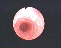 Obr. 4 – Endoskopie rok po spojce bez nálezu varixů