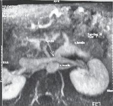 Obr. 9 – Kontrolní MRI zobrazení splenorenální spojky