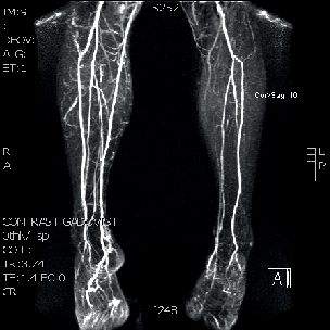 Obraz bércového řečiště, vpravo kontaminace žilního systému VMS