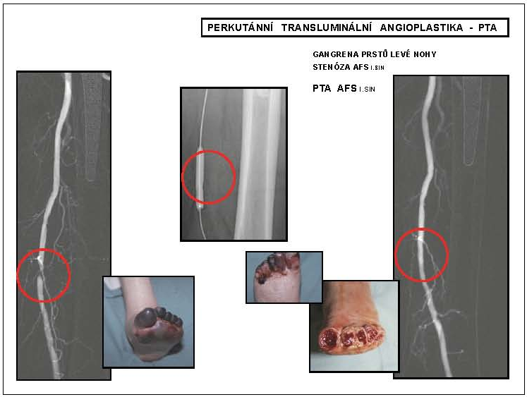 Obr. 4 – Perkutánní transluminální angioplastika – PTA * AFS l.sin – arteria femoralis superfi cialis na levé dolní končetině