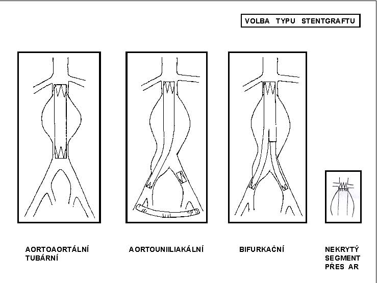 Obr. 11 – Volba typu stentgraftu