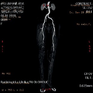 CT ag arteriálního řečiště v celém rozsahu