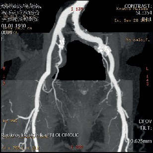 CT ag arteriálního řečiště v detailu II