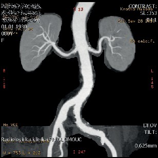 CT ag arteriálního řečiště v detailu I