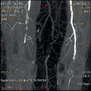 CT ag arteriálního řečiště v detailu IV
