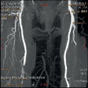 CT ag arteriálního řečiště v detailu III