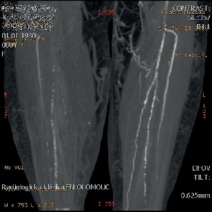 CT ag arteriálního řečiště v detailu V