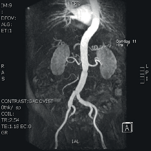 Ag, tubární aortální náhrada
