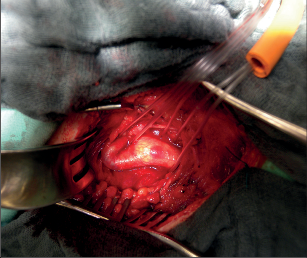 Obr. 6a Kinking vnitřní aorty