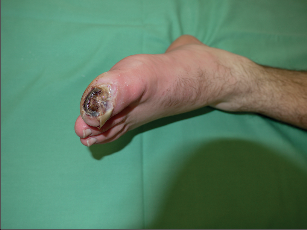 Vlhká gangréna palce