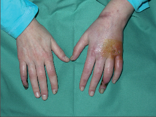Ischemie prstů a ruky při Raynaudově chorobě