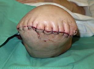 Amputace ve stehně, sutura pahýlu