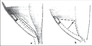 Obr. 11 – Příznivý (a) a nepříznivý (b) typ třísla. Šipka znázorňuje větší vzdálenost dolního okraje vnitřního šikmého a aponeurózy příčného břišního svalu od tříselného vazu