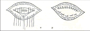 Obr. 13 – Operace pupeční kýly podle Mayo; a – steh branky a zákládání stehů zdvojujících fascii b – ukončená plastika