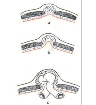 Obr. 16 – Vývoj kýly v bílé čáře a – preperitoneální lipom b – preperitoneální lipom s prázdným kýlním vakem c – vyvinutá kýla s obsahem