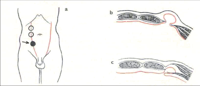 Obr. 18 – Hernia lineae semilunaris (Spiegeli) a – lokalizace kýly (černě označeno místo nejčastějšího výskytu), b – typická kýla, c – intersticiální kýla mezi vrstvami stěny břišní