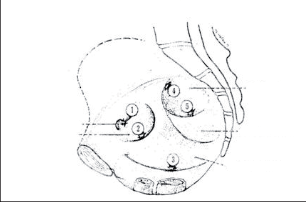 Obr. 20 – Pohled z dutiny břišní na pánevní stěnu: 1 – hernia obturatoria 2 – hernia ischiorektalis 3 – hernia perinealis 4 – hernia suprapiriformis 5 – hernia infrapiriformis.