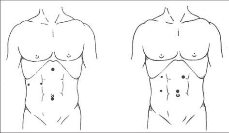 Obr. 2 – Možnosti umístění trokarů při laparoskopické cholecystektomii