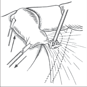 Obr. 4b – Klipování ductus cysticus
