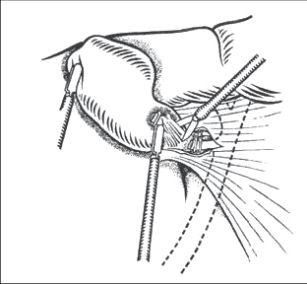Obr. 6 – Dokončení izolace žlučníku z lůžka pomocí nůžek