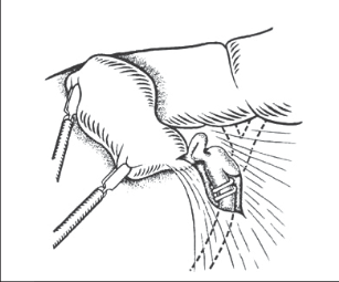 Obr. 7 – Chybná identifikace ductus cysticus – klipy nasazené na ductus choledochus