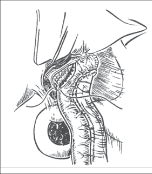 Obr. 10 – Hepatikojejunoanastomóza v jaterním hilu s prodloužením spojky na levý hepatikus (Couinaud-Heppova operace)